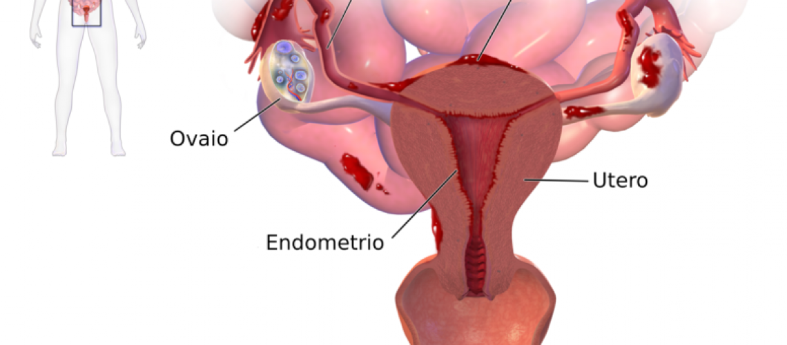 776px-Blausen_0349_Endometriosis-it